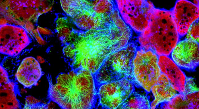 Células de cáncer y tratamiento oncológico de precisión