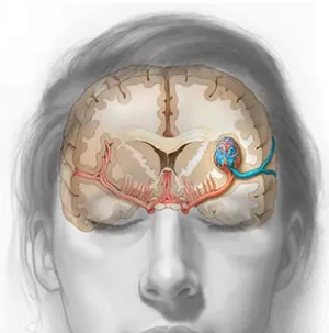 Tratamiento de malformaciones arteriovenosas con Gamma Knife