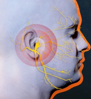 Tratamiento de neuralgia del trigémino con Gamma Knife