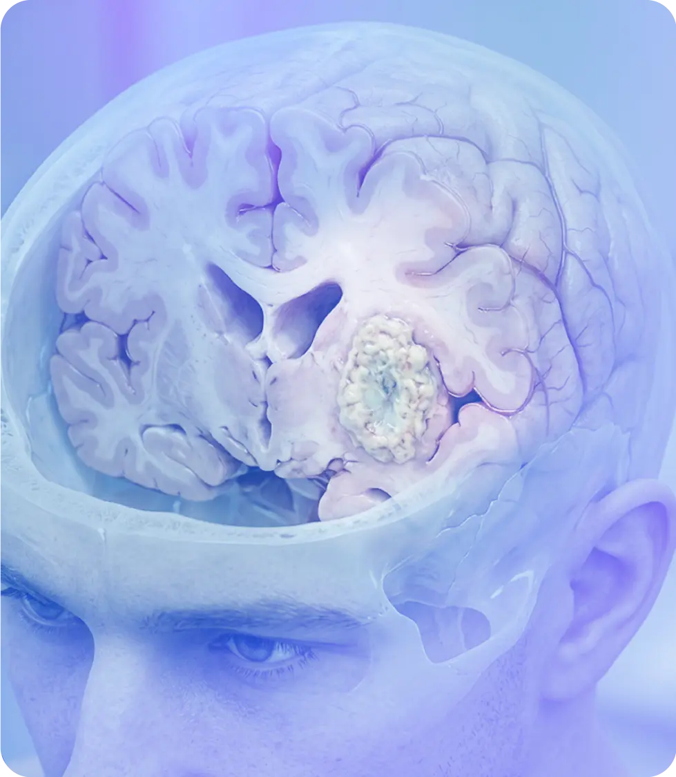 Sistema de radiocirugía estereotáctica Gamma Knife